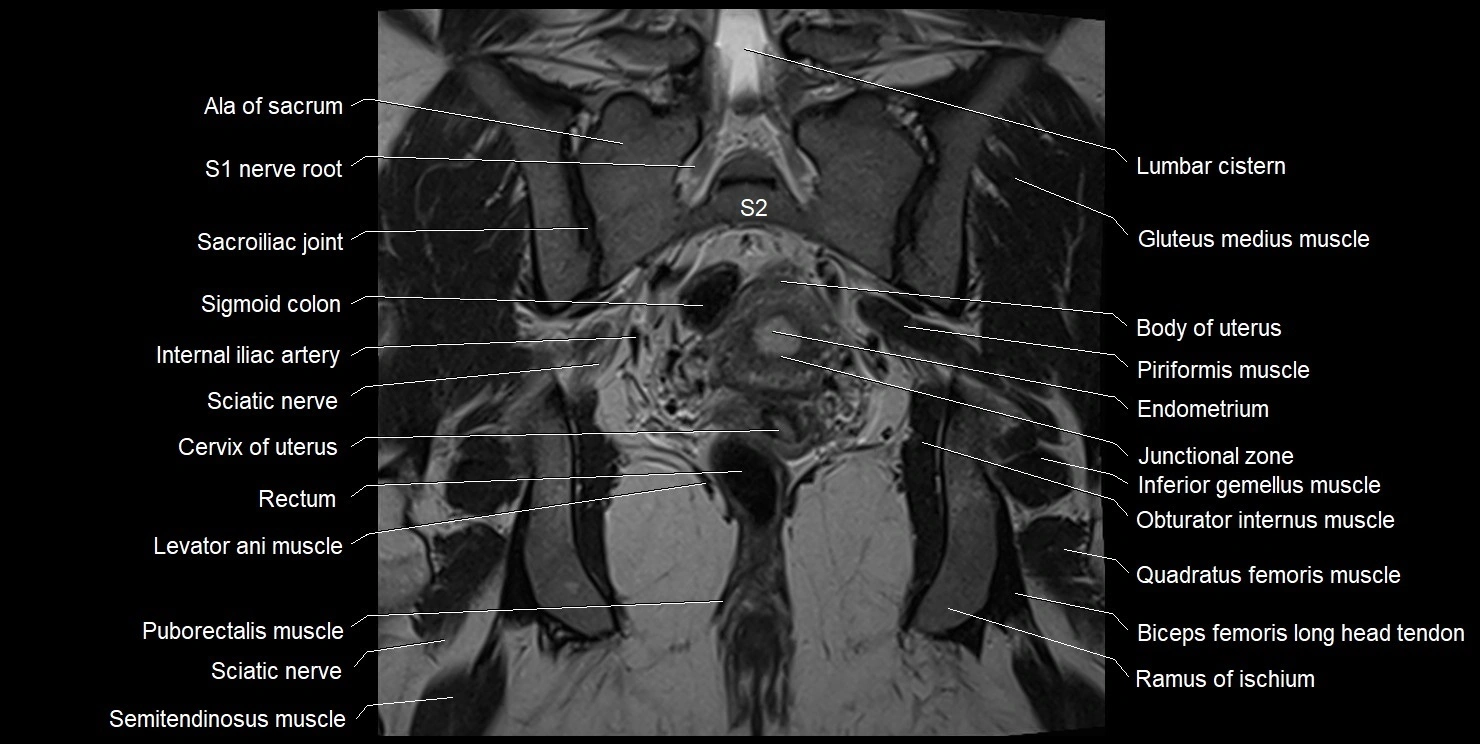 female pelvis coronal cross sectional anatomy image 24.webp